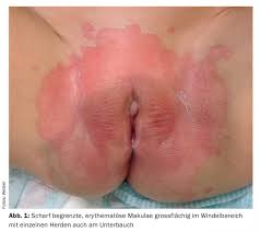 Image result for diaper dermatitis