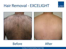 In conclusion, laser hair removal treatments are an optimum choice because they simply are less costly than other hair removal options. Laser Hair Removal Ipl Marsh Medical Skin Clinic Huddersfield West Yorkshire