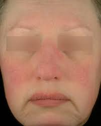 Symptomes joues rouges et chaudes. Les Types De Rosacee I Bouffees De Chaleur Et Rougeurs Au Visage