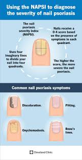 Image result for Pitting nails feet