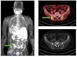 Radiation therapy is an effective treatment that kills prostate cancer cells by using high energy rays or particles. Scan For Prostate Cancer Charter Radiology