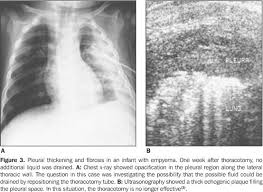 Send aspirated fluid for cytology. Scielo Brasil Papel Da Ultra Sonografia Na Avaliacao Da Efusao Pleural Papel Da Ultra Sonografia Na Avaliacao Da Efusao Pleural