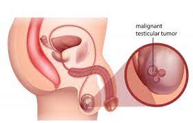 If you notice any symptoms, have a nurse or doctor take a look. Testicular Cancer Signs Symptoms And Treatment Options Onco Com