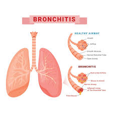 Image result for Chronic Bronchitis