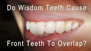 This leads to teeth shifting in a few ways. Do Wisdom Teeth Cause Front Teeth To Overlap And Get Crowded Youtube