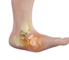 The detailed pathomechanism of the disease is still unclear. Charcot Foot Deformity Southlake Tx Charcot Arthropathy Fort Worth Tx