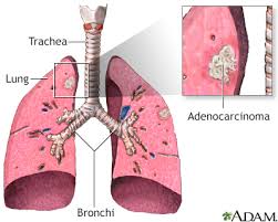 Identify treatment options for lung cancer. Lung Cancer Small Cell Information Mount Sinai New York