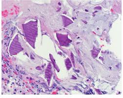 Image result for Kayexalate