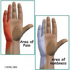 Pin By Dr Steve Phillips Chiropract On Knowing My Body Cubital Tunnel Syndrome Ulnar Nerve Ulnar Nerve Entrapment