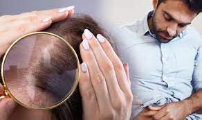 A high sugar intake spikes your blood sugar levels. Type 2 Diabetes Symptoms Hair Loss Can Be A Sign Of Dangerously High Blood Sugar Express Co Uk