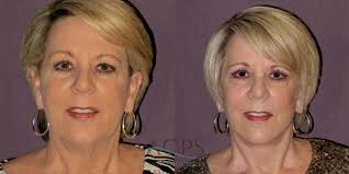 Facelift in Houston, TX