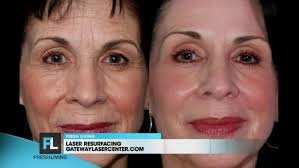 News and insights across the medical and aesthetics industry. Gateway Aesthetic Laser Resurfacing Kutv