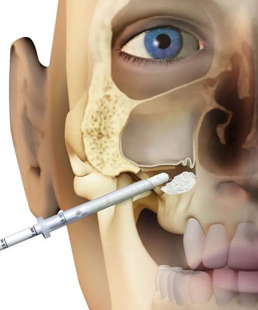 Sinus lift surgery for Dental Implants - Omnia Dental Clinic