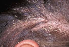 Slideshow What Your Hair Scalp Say About Your Health Severe Dandruff Scalp Psoriasis Treatment Dandruff Treatment