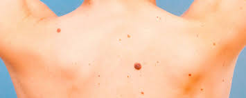 Being armed with information is vital to begin the fight. How To Tell If Moles Are Skin Cancer Teen Vogue