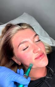 If there's one treatment I would recommend to every client it would be  microneedling 💗 Did you know that it can stimulate collagen production by  400% ‼️ Studies show that the collagen