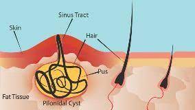 Ingrown hairs are, for many people, an unfortunate fact of hair removal. What Is Pilonidal Cyst Symptoms Causes Diagnosis Treatment And Prevention Everyday Health