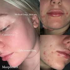 SKIN GLOW UP ✨ My skin has had pimples, breakouts, scarring since I was  literally 13. I went