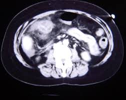 Image result for Neutropenic Colitis
