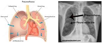 Image result for Pneumothorax