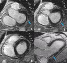 Markedly angled, you can angle the axial images. Suspected Subclinical Myocarditis Detected By Cardiac Magnetic Resonance Imaging Late Post Covid 19 Recovery Journal Of Cardiology Cases