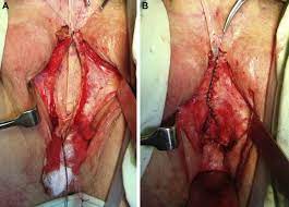 Male to female surgery pictures. Reversal Surgery In Regretful Male To Female Transsexuals After Sex Reassignment Surgery Sciencedirect