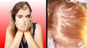 Sep 18, 2015 · amel bent : L Alopecie Mon Cauchemar Ma Solution Youtube