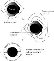 Image result for nevus sclerae
