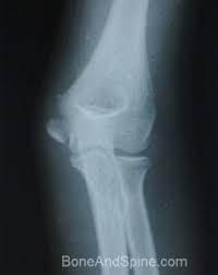 Iso lateral row lateral flow test lateral raise machine standing lateral raise iso lateral chest press lateral file cabinet unloader knee brace left medial motorized lateral exercise machines portable lateral locking filing cabinets lateral flow cassettes. Xrays Of Elbow Injuries Bone And Spine