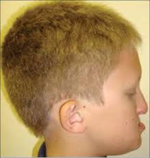 Gene P63 In Ectrodactyly Ectodermal Dysplasia Clefting Ankyloblepharon Ectodermal Dysplasia Rapp Hodgkin Syndrome Straten Cv Butow Kw Ann Maxillofac Surg