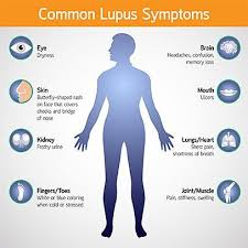 Find out about treatment and how you can ease your symptoms. Signs And Symptoms Of Lupus Everyday Health