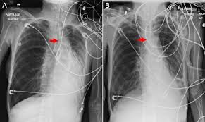 Image result for Atelectasis