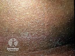 Image result for sweat rash on back