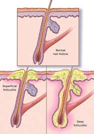 Image result for folliculitis symptoms