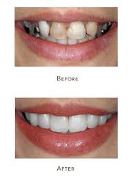 This life span takes into account how well the patient cares for their veneers proper care for composite resin veneers. Dental Veneers Houston Porcelain Veneers Cost Memorial Houston Tx