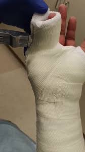 Image result for Ulnar Gutter Cast