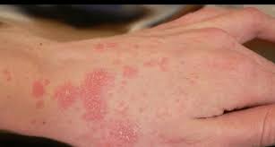 Image result for scabies on humans