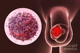 Image result for Penile Cancer