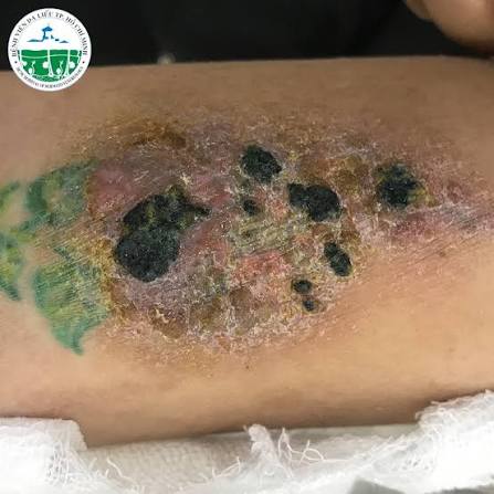 Minh họa phản ứng dị ứng da khi sử dụng mực xăm hình trên cơ thể người dị ứng