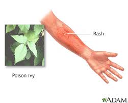 It typically takes 2 to 3 weeks. Poison Ivy Oak Sumac Rash Information Mount Sinai New York
