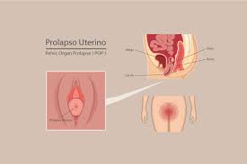 Prolapso Uterino Dra Teresa Aznar