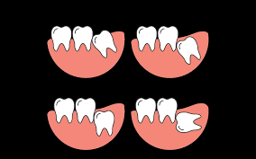 Wondering how much having your wisdom teeth removed will cost? Wisdom Teeth Removal Tooth Extraction Maven Dental