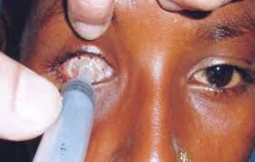 Image result for Eye Tray