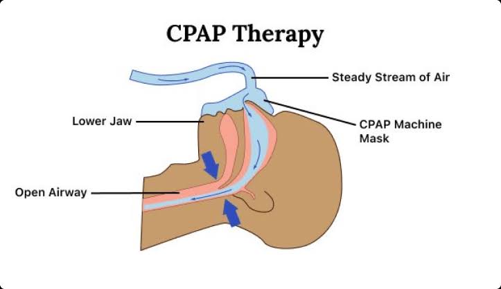 Continuous Positive Airway Pressure (CPAP) maintaining airway patency, AI generated