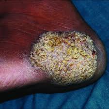 She reports that in 91 per cent of papulonecrotic tuberculosis of the skin, in more than 66 per cent of erythema indurativa bazin and tuberculosis verrucosa cutis, and in more than 58 per cent of scrofuloderma, she was able to demon­strate an internal focus of the disease. Pdf Epithelioid Cell Granuloma