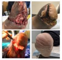 Can Fish Skin Grafts Have An Impact For Complex Diabetic Lower Extremity Wounds Podiatry Today