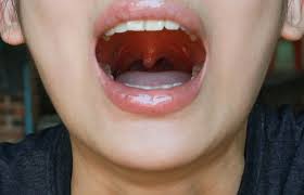 Image result for Uvulitis