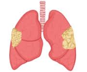 pleural mesothelioma attacks the lungs and respiratory area of the body. Pleural Mesothelioma Causes Risk Factors And Symptoms
