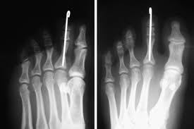 Image result for Interphalangeal Dislocation