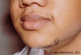 Genetic history, hormonal imbalance, aging, and more could be the reason for facial hair growth. Hirsutism American Osteopathic College Of Dermatology Aocd
